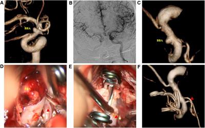 Clip-reinforced wrapping using the Y-shaped temporalis fascia technique for intracranial aneurysms